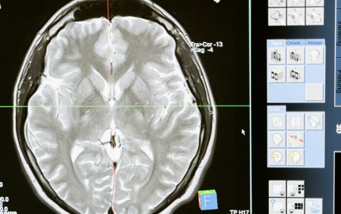 Radiology brain scan