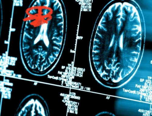 New Algorithm Can Diagnose Stroke with 83 Percent Accuracy