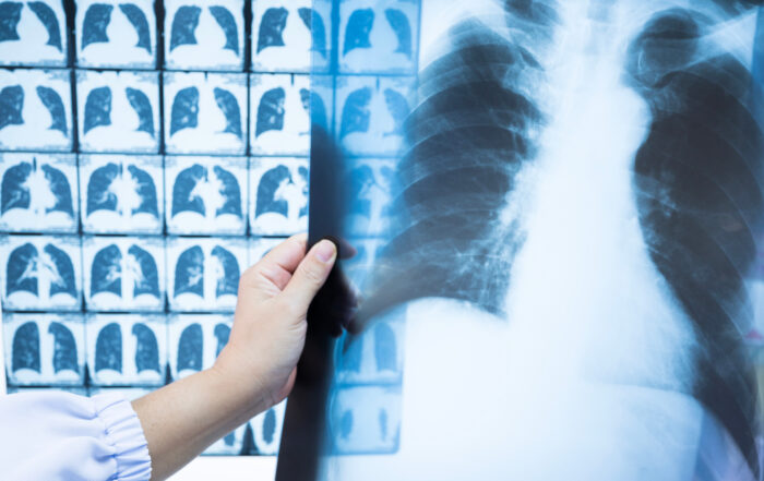 A person holding an X-ray film of a human chest in front of a computer screen with more medical images.