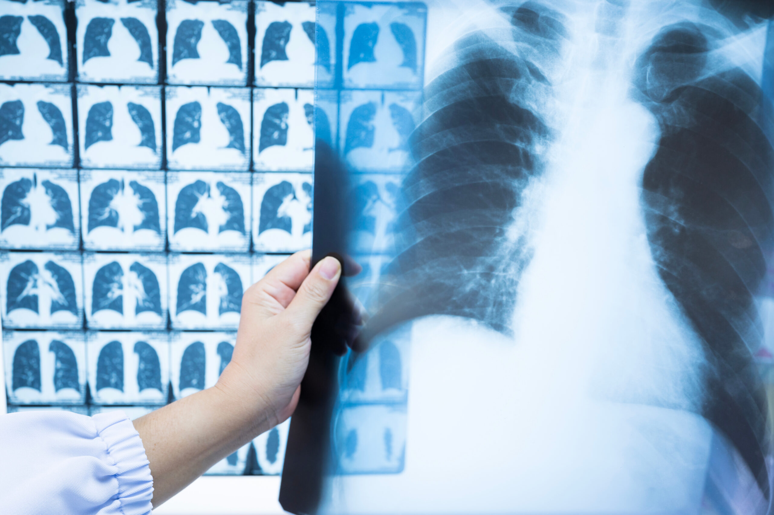 A person holding an X-ray film of a human chest in front of a computer screen with more medical images.